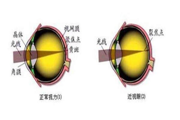 東盛堂近視恢復(fù)