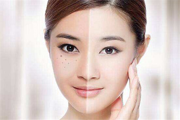 君蘋美祛斑祛痘