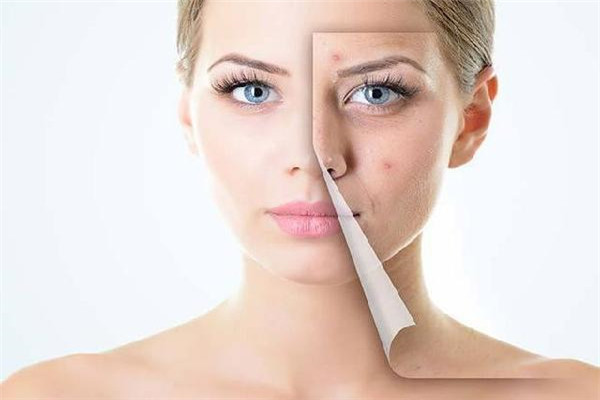 君蘋美祛斑祛痘